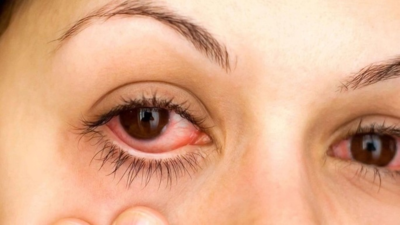 Yeni Bulaşıcı “Kırmızı Göz” Hastalığı Alarmı: Vaka Sayısı 7 Bin 500’ü Aştı