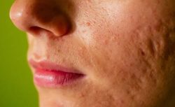 Binlerce liralık masraftan kurtulun: Sivilce çukurları nasıl geçer? İşte uzmanların önerdiği en etkili yöntemler