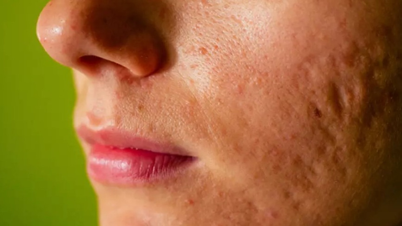 Binlerce liralık masraftan kurtulun: Sivilce çukurları nasıl geçer? İşte uzmanların önerdiği en etkili yöntemler